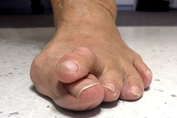 hammertoe