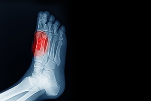 Foot Pain Caused by Sesamoiditis