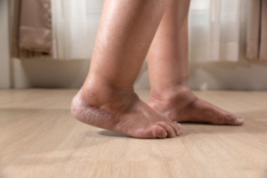 What Are Causes of Swollen Feet and Ankles?