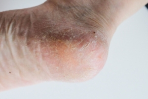 What Can Cause Cracked Heels?