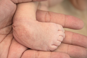 Clubfoot Occurs When Feet Take a Different Path