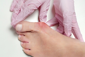 Considering Bunion Surgery?