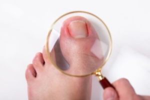 Ingrown Toenails and the Benefits of Podiatric Care