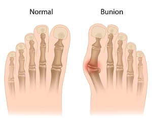 Juvenile Hallux Valgus
