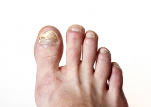 Infections May Accompany Severe Toenail Fungus