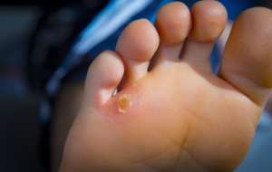 What Happens When Corns Rub You the Wrong Way