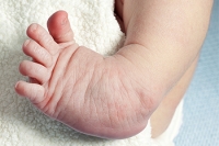 Definition, Causes, and Treatment of Clubfoot