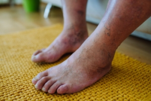 Understanding Diabetic Foot Ulcers