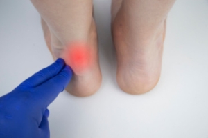 Facts About Achilles Tendinitis