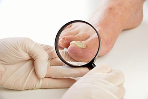 Home Care for Toenail Fungus