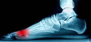 Sesamoiditis And Running