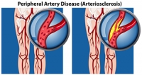 Peripheral Artery Disease Can Affect Your Feet