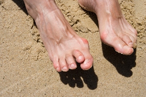 Causes and Treatment for Hammertoe in Women