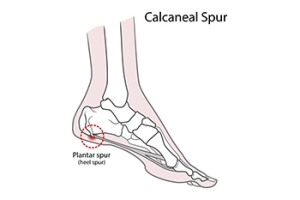 Source of Heel Pain May Be Calcaneal Spurs