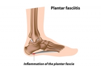 Chronic Plantar Fasciitis