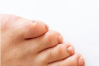 Understanding Corns and How They Differ From Calluses