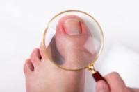 Causes of Ingrown Toenails