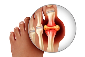 How Gout Affects the Feet