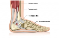 What to Expect in Healing From an Achilles Tendon Injury