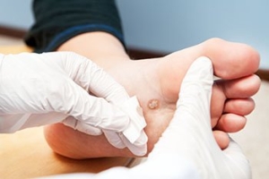Painful, Persistent Plantar Warts
