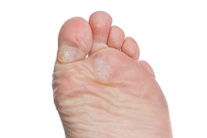 How to Deal With Calluses on the Feet