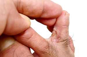 An Itch Not to Ignore