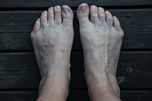 Facts About Tailor's Bunion